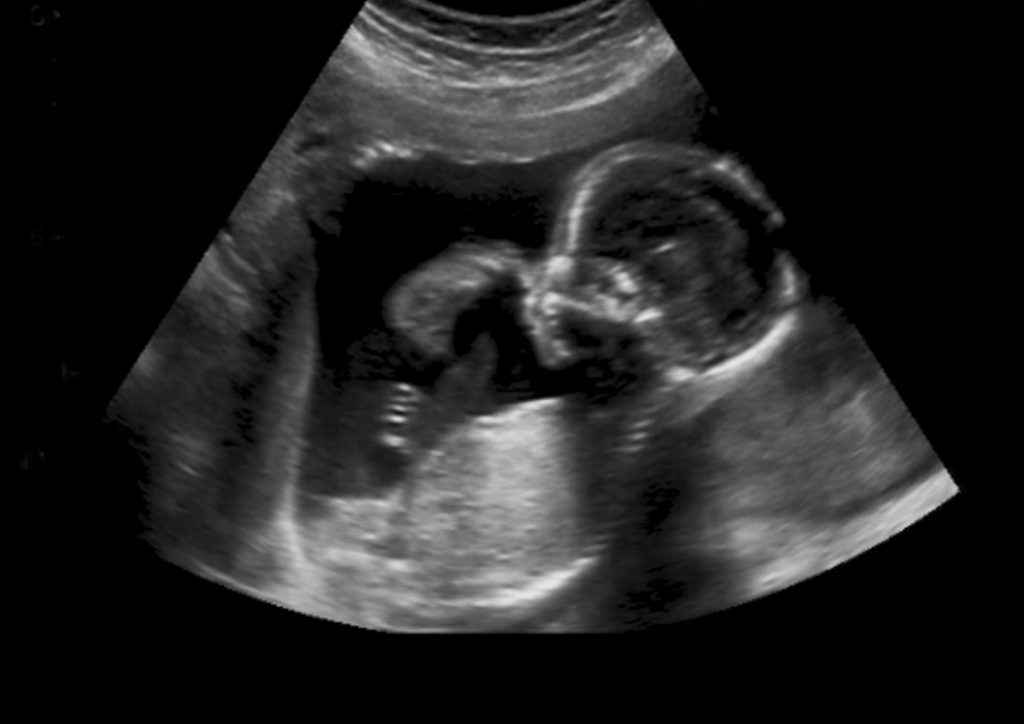 Pregnancy Ultrasound Training Second and Third Trimester